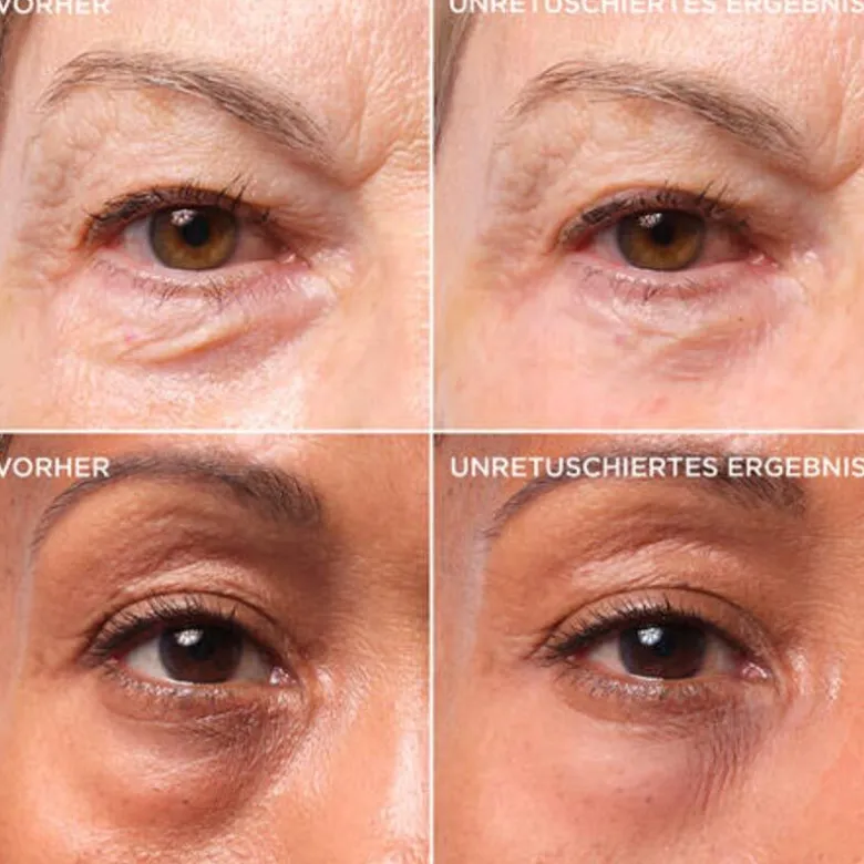 Bye Bye Under Eye Bags