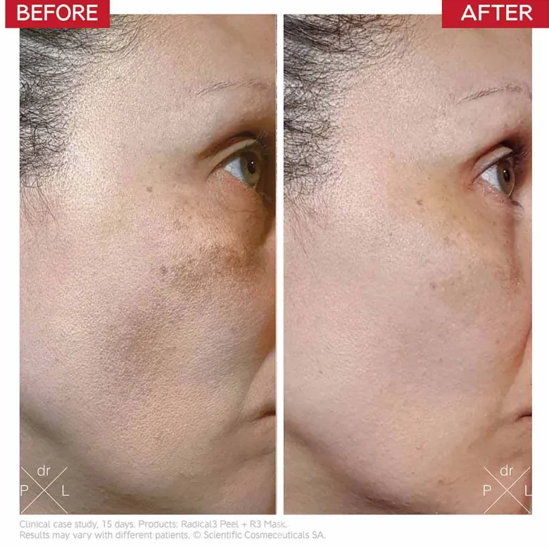 Radical3 Reboot Pro Peel
