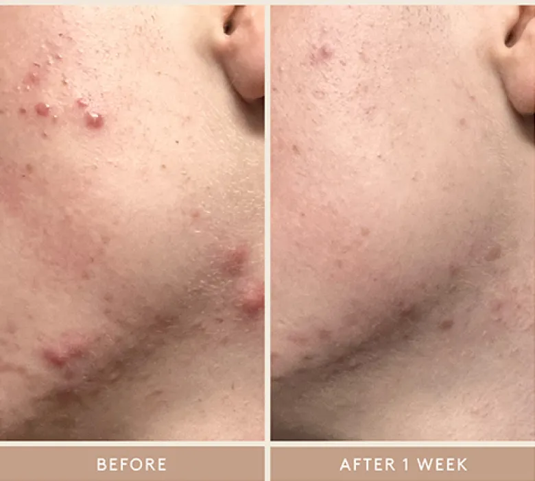Rescue Serum with 10% Azelaic Complex
