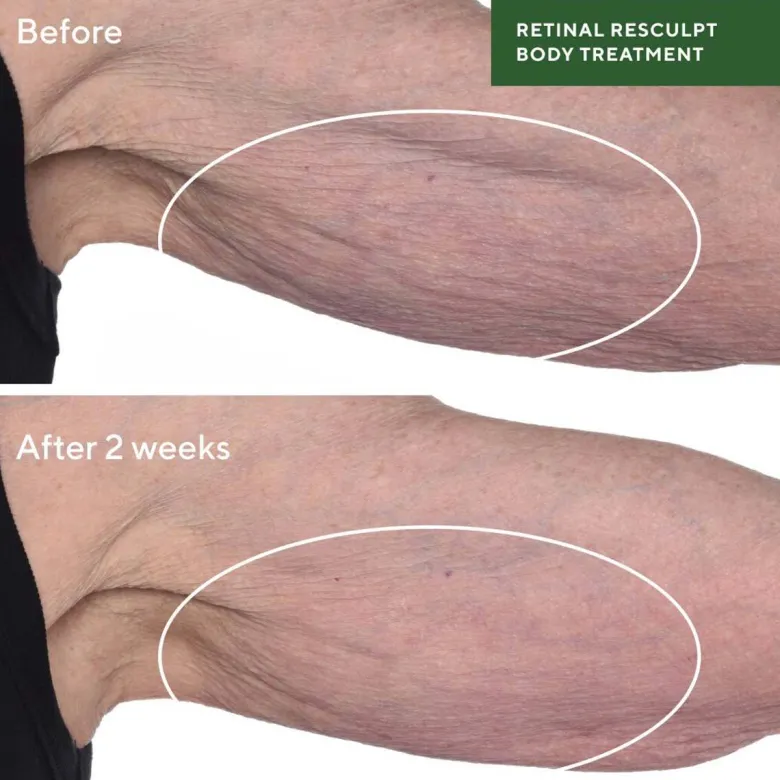 Retinal Resculpt Body Treatment