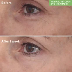 RETINAL RESCULPT EYE TREATMENT