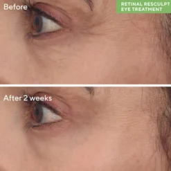 RETINAL RESCULPT EYE TREATMENT