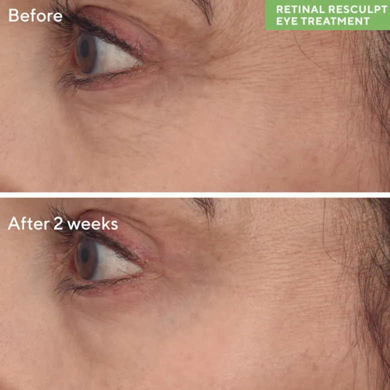 RETINAL RESCULPT EYE TREATMENT