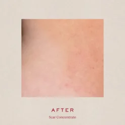 Scar Concentrate