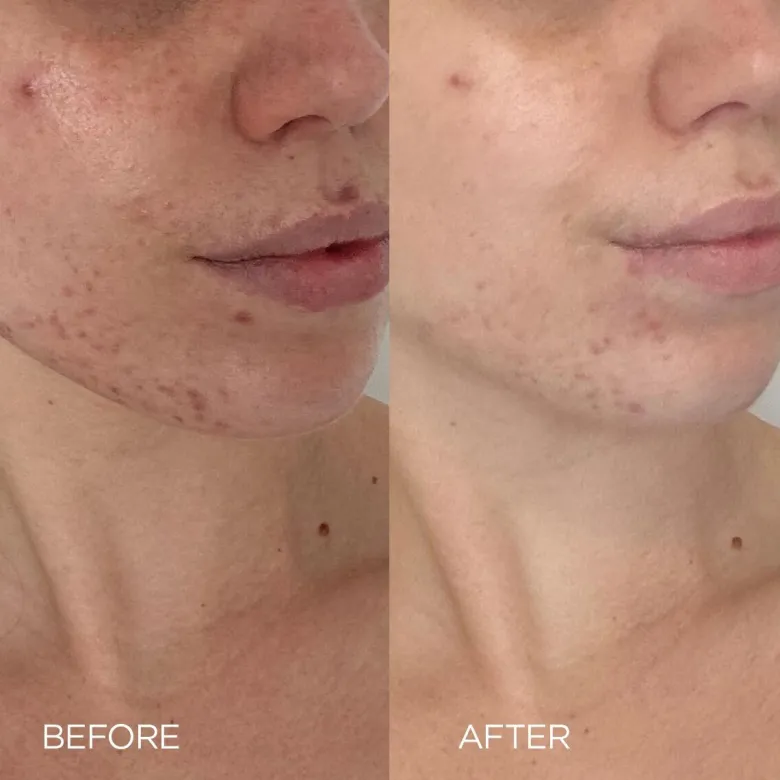 Supernatural Blemish Serum