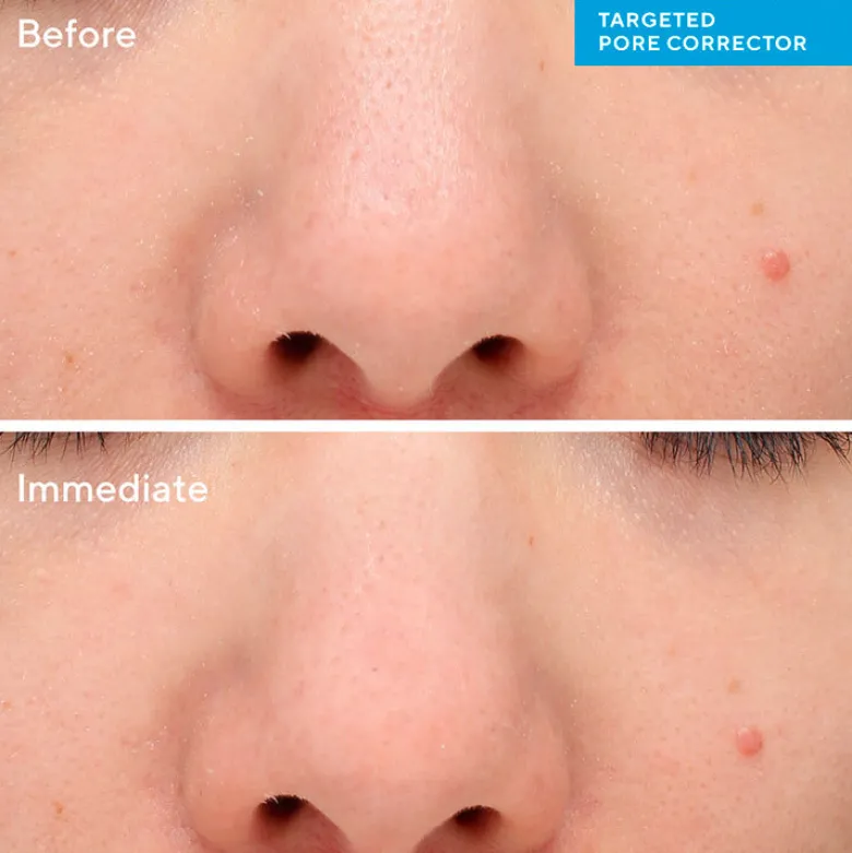 Targeted Pore Corrector