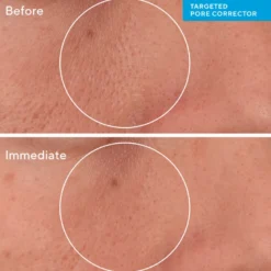 Targeted Pore Corrector