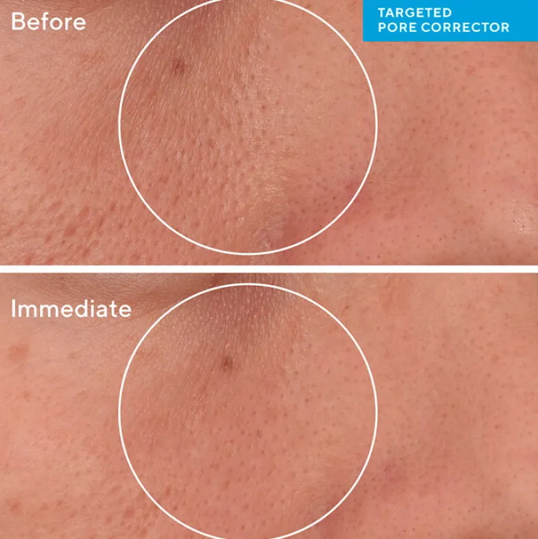 Targeted Pore Corrector
