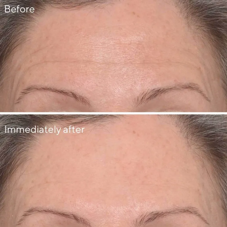 Targeted Wrinkle Corrector