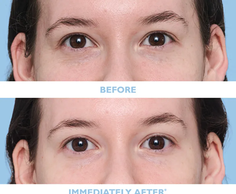TOTAL EYE RESET 4-PAIR SET